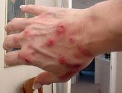 Papeln auf der Haut mit Helminthiasis